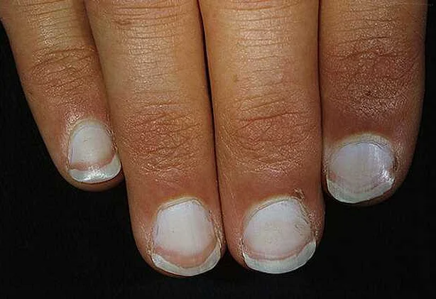 Утолщение или тонкие ногти могут быть связаны с психическим состоянием