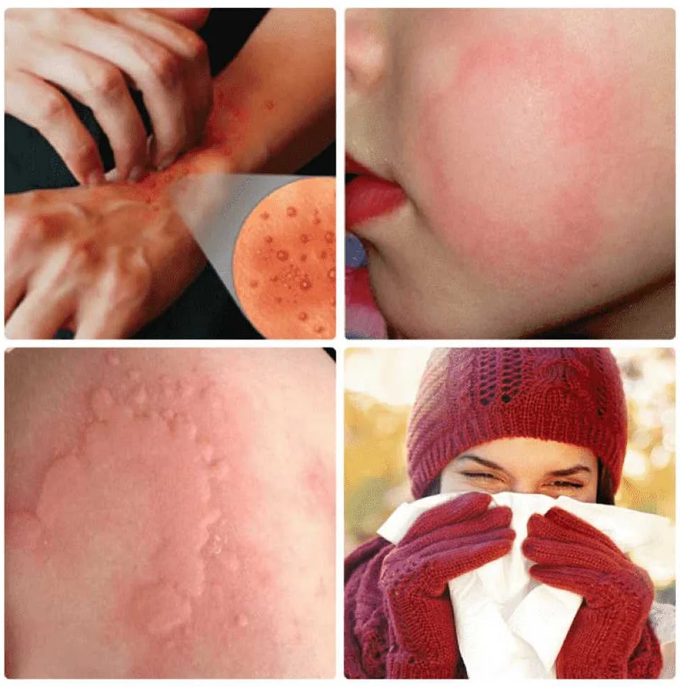Что такое аллергия на холод?