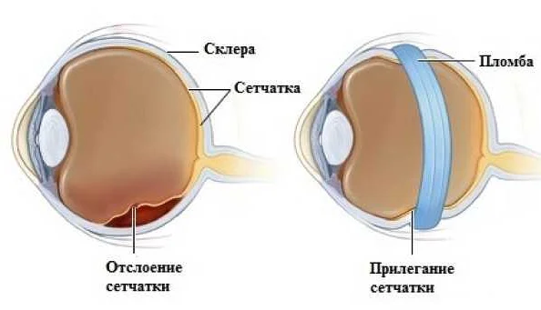 Уколы для глаз при отслоении сетчатки. Отслоение белочной оболочки. Операция хирургия по отслоение сетчатки глаза.